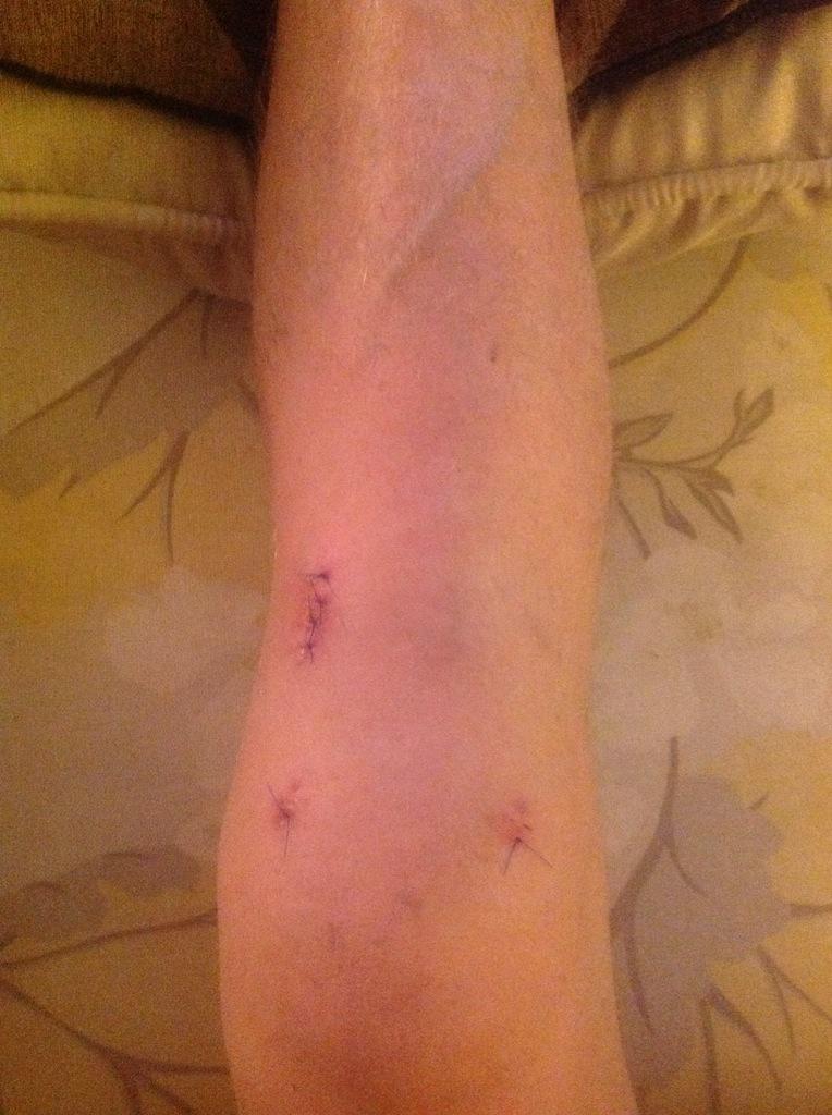 RobCullen9's tweet photo. Healing v. Nicely! #aclreconstruction #meniscusreplacement #gohardorgohome #NoPainNoGain http://t.co/apUbqJaijw