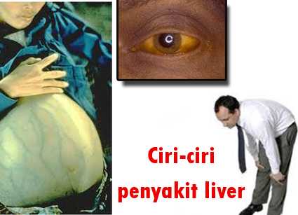 Penyakit liver