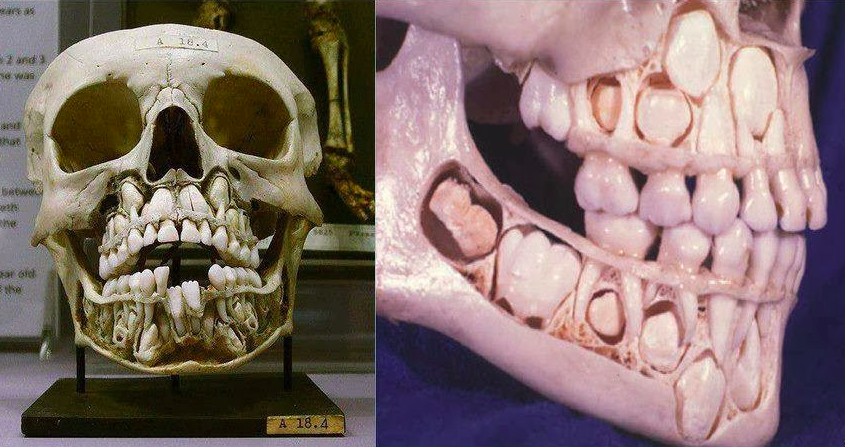 The scarily awesome view of a child's skull shows the teeth inside the mandible waiting to replace the baby teeth.