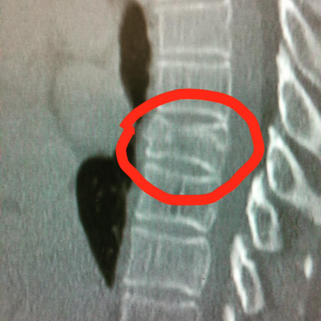 allspecialneeds's tweet image. Did first training walk tonight since fracturing my back. Only 4 weeks till next leg of #SouthWest630. Lovely evening