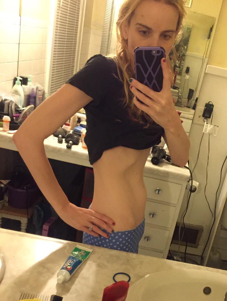 TheCrohnsRanger's tweet photo. 97 lbs. not the lowest I've ever been, but still waaaay too skinny. #crohns #IBD #crohnieproblems #weightloss http://t.co/XuzU1NPFa3