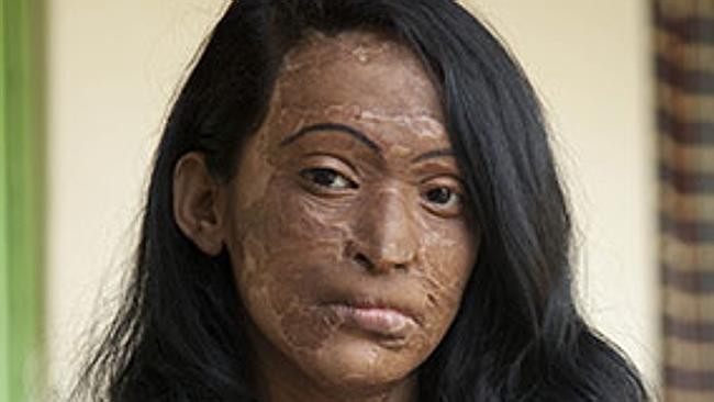 These Female Victims Of Acid Attacks Tell Their Horrifying Stories Scoopnest