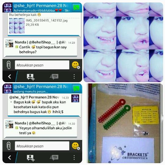 BehelStoreID's tweet image. BehelnyaBagus💕
behel permanen metal 
lengkap tinggal bwa k dokter
450rb -&amp;gt; jadi 200 rb 

FREEONGKIR😊

Pin 328498a7
