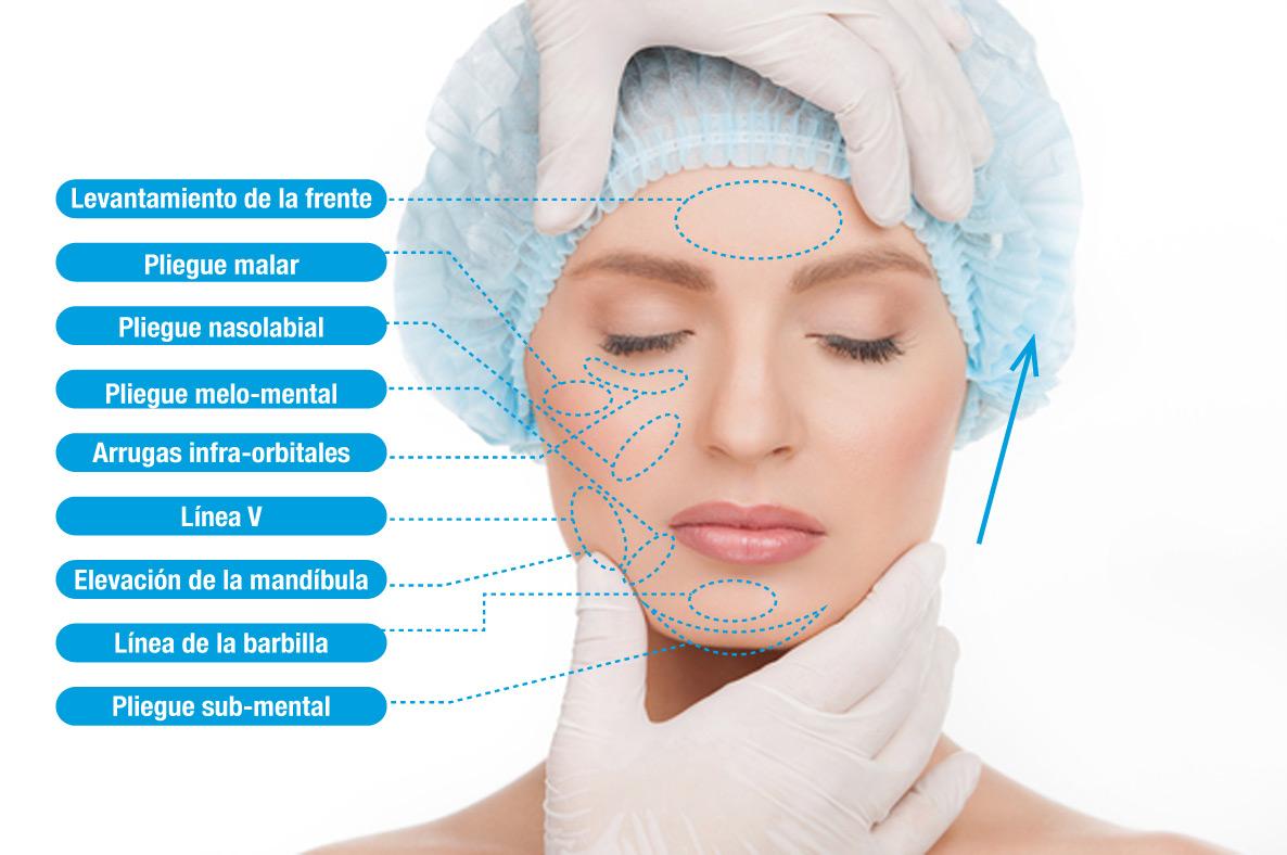 CanalSaludHogar's tweet image. ¿Cómo funcionan los #hilosTensoresEspiculados? Descúbrelo en--&amp;gt; bit.ly/1BPiolm #LiftingSinCirugía #HiloTensor