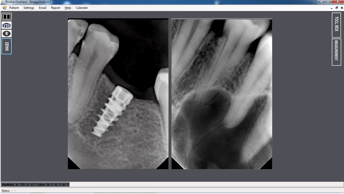 oradectpro's tweet image. Achieving #maximal image quality with #minimal radiation exposure, #OraDect sensors are designed to optimize low rad.