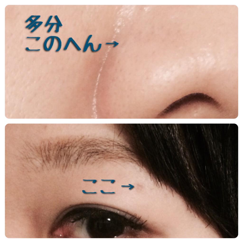 Y B Nice Smooth 顔のほくろを1年半前にレーザーで取ったのだけど小鼻のはもうほぼ跡形もなくなった 瞼のは色は残ったもののフラットになっただけで御の字 どちらも 7 000くらいで済んだしいずれ大きくなってコンプレックスになるならと早めに取って良かっ
