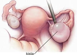 Ini Pantangan Makanan Bagi Penderita Penyakit Kista - AnekaNews.top