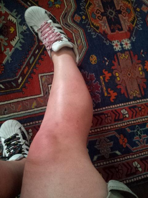 lollipops2312's tweet image. Mangiata VivAaaaa!!
Zanzare....maledette!!!
Per oggi avete fatto pranzo e cena!!!
#helpdoctor...!!