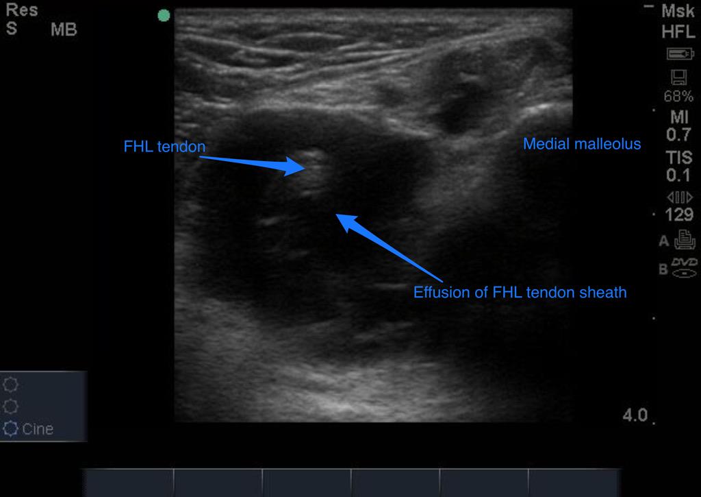 Large FHL effusion today in clinic, previous managed as Tib Post..#changemanagement #mskus
