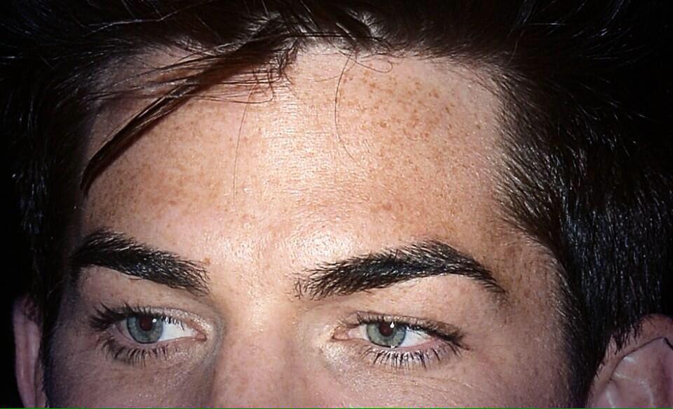 freckles:')))