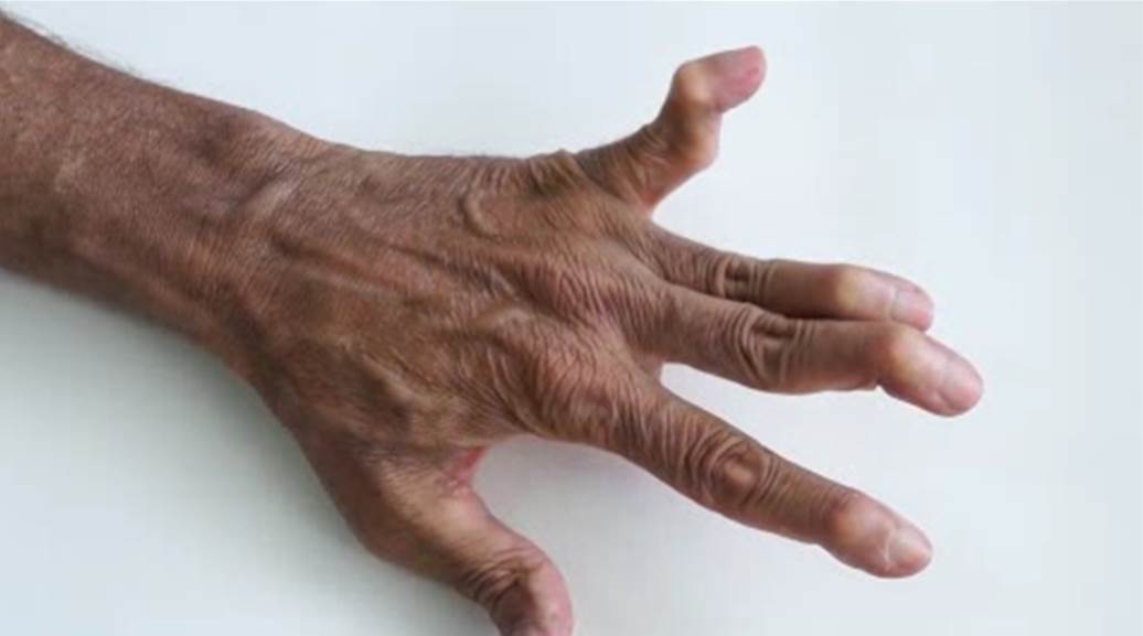 DrAiLynTan's tweet photo. Video of #Jaccoud’s arthropathy affecting hand movements in #lupus #SLE
http://t.co/7nEhjFCoC1
#rheumedu http://t.co/bwwC9E3plH