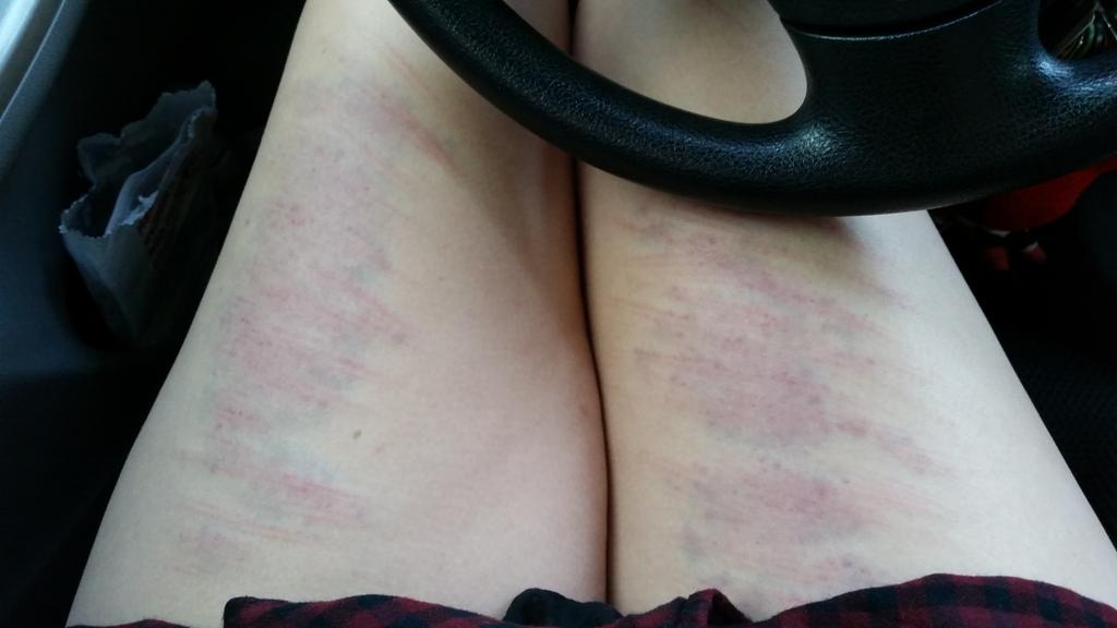 VandaKors's tweet photo. thigh caning. *note I do not do caning at the Dominion this was my private life* http://t.co/9DwovoskPb