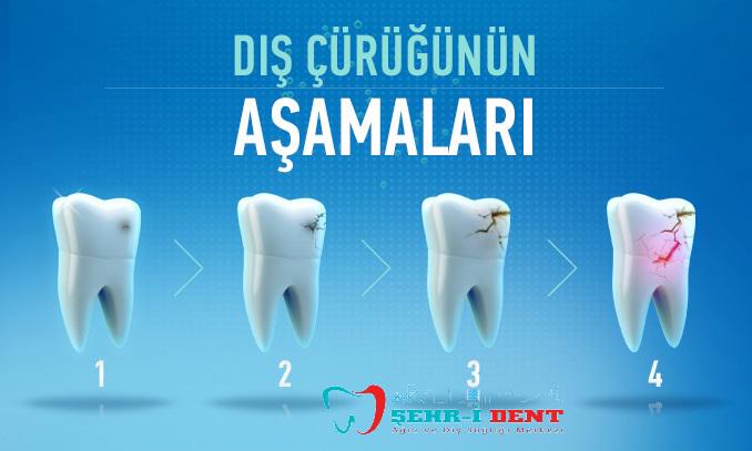 #diş #çürüklerinin #aşamaları