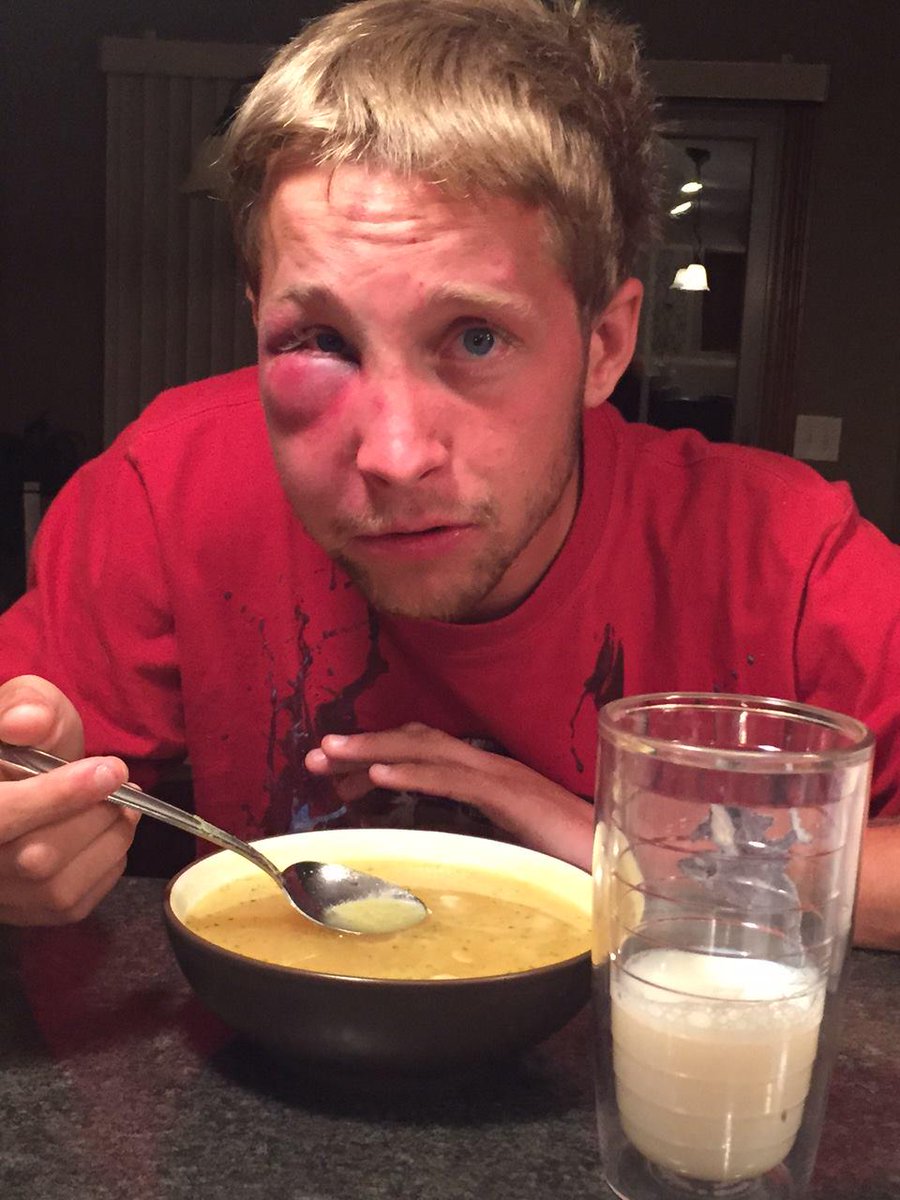Cosmopolitan's tweet photo. Teen With Asperger's Wants to Educate His Bullies After They Severely Beat Him http://t.co/I2fLjskPbp http://t.co/wDJ72m8EeH