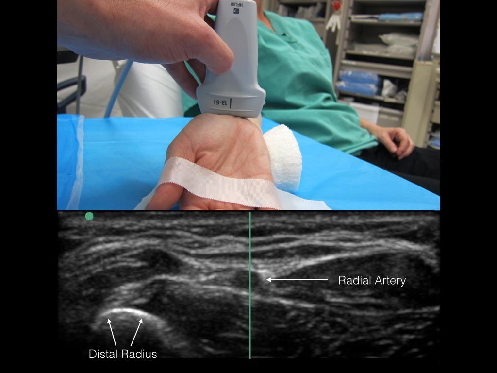 NagdevArun's tweet photo. performing an A-line? use M-mode marker to ensure artery = middle of the probe. reduce error &amp; improve success http://t.co/d7L5MHEjIM