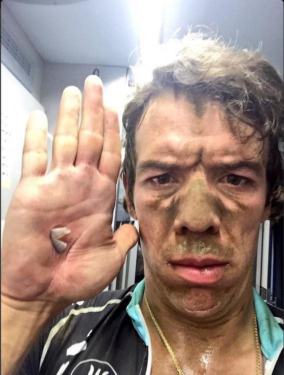 Así quedó la mano de <a href="/UranRigoberto/">Rigoberto Uran</a> luego de la difícil etapa de Pavé. bit.ly/1LUN0VU