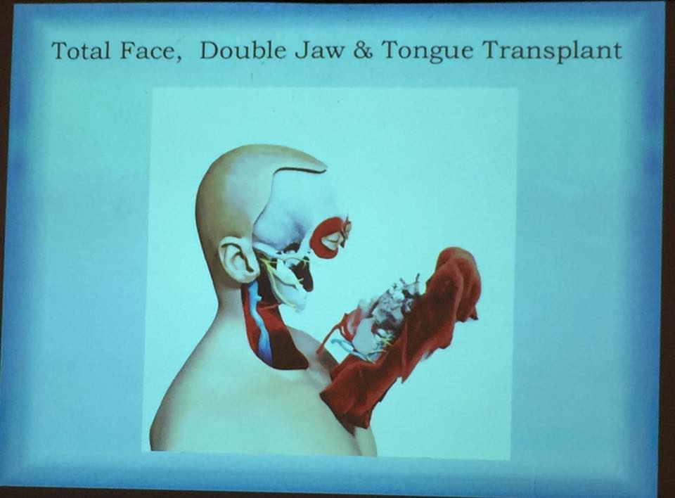 In #FaceTransplants you may have skin, muscles, tongue, nerves, bone, etc. to deal with. #TransplantEthics #MedEthics