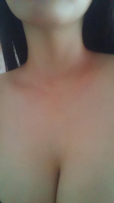 いきなり真っ赤になって痒い(&acute;&times;&omega;&times;`) http://t.co/4siPse92MR