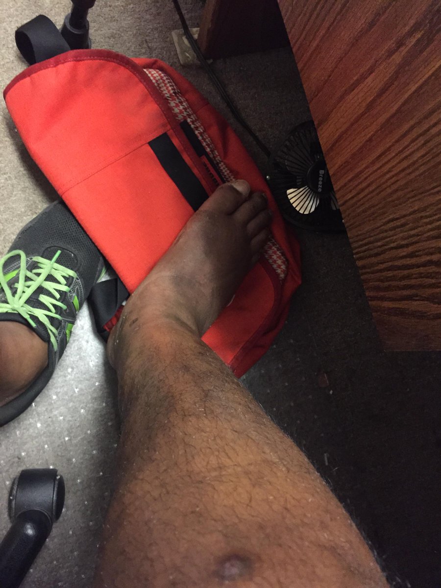 TheBionicScoop's tweet image. It looks straight again. #TibFib