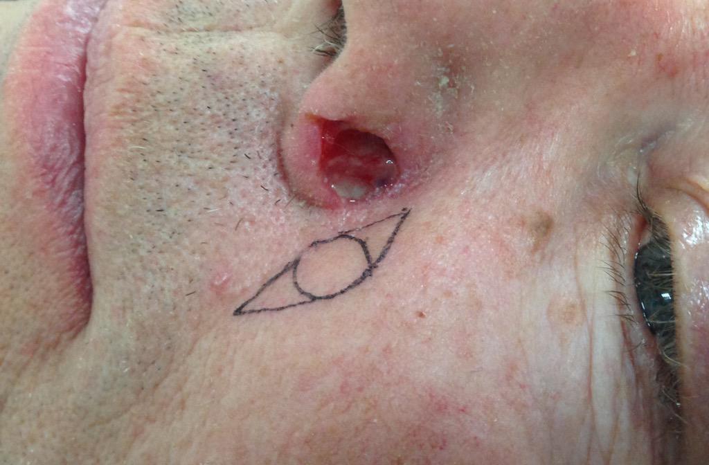 EnFaceClinique's tweet photo. Eilandflapje ter sluiting defect neusvleugel http://t.co/RT4TYRwn6h