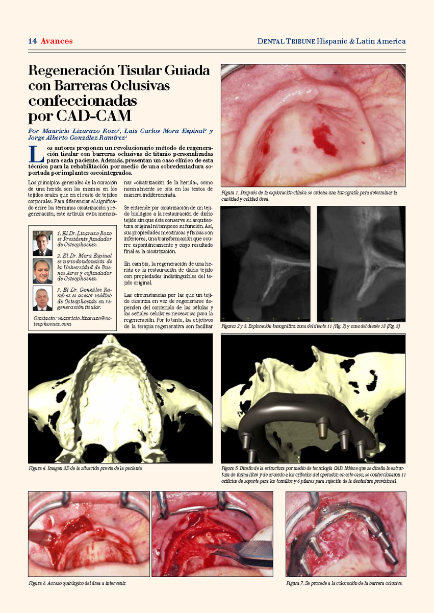 EdentalBta's tweet photo. #Osteophoenix #Avanza en #Regeneración #Osea http://t.co/jVxdFfUyPs