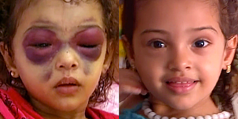 Channel4News's tweet photo. 4-year-old Niema suffered a fractured skull in the Gaza conflict last year. This is her today: http://t.co/5dytEjf52u http://t.co/z367IKqpZw