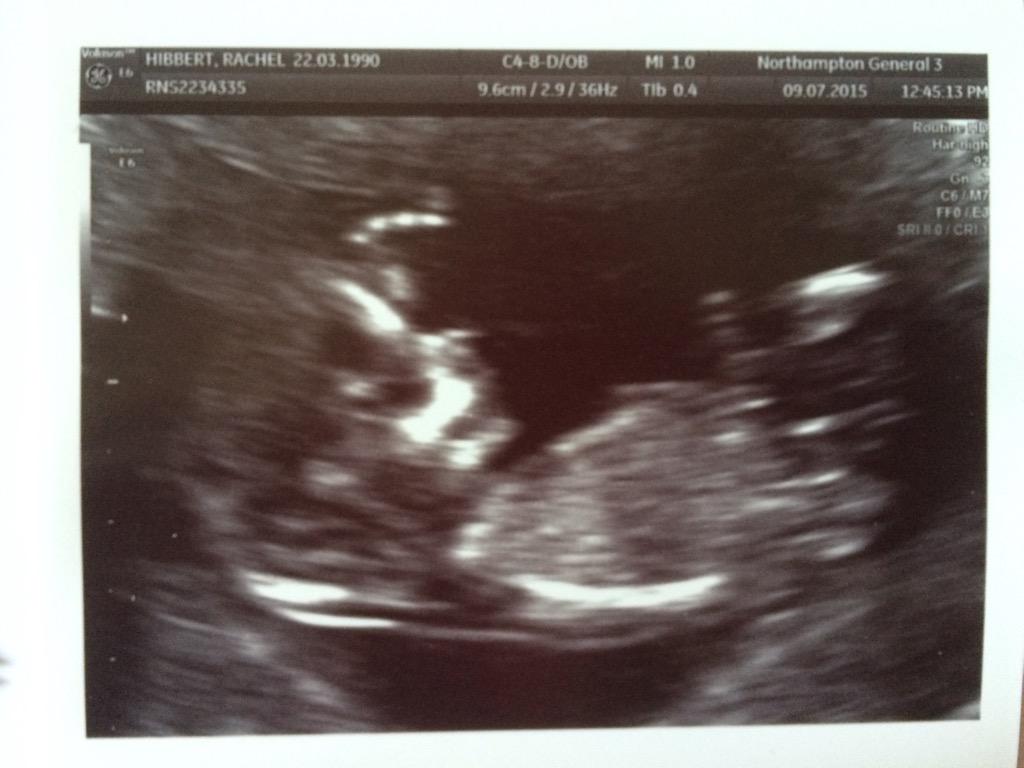 rachie2203's tweet photo. Here's our little bundle of joy 😍 due January ❤️ we are over the moon. #babydenman @GazDenman90 http://t.co/hrHyYcDfQE