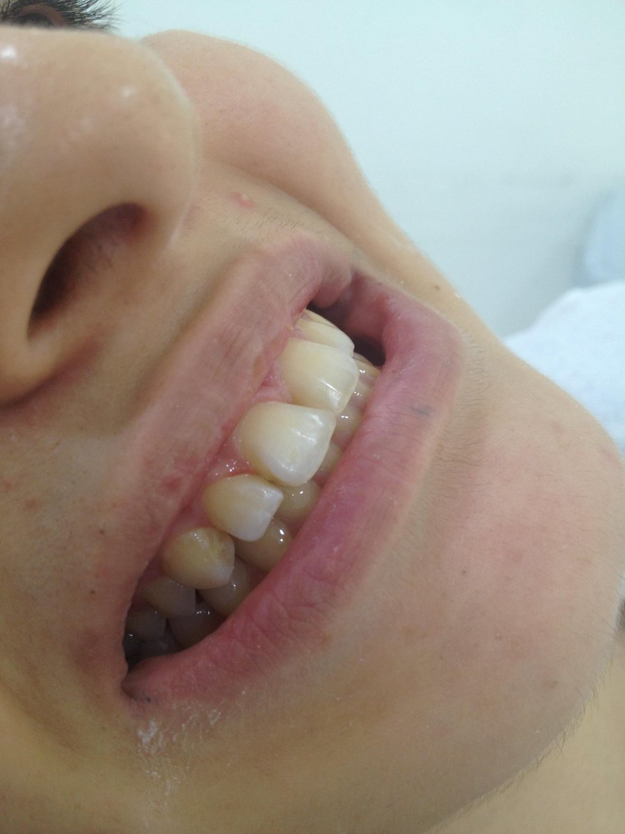 MERKEZİMİZDE DİASTEMA (ARALIKLI DİŞ ) TEDAVİSİ