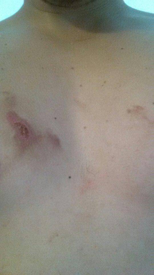 TKetzmerick's tweet photo. nice chemical burn from the foam party on s trip http://t.co/mkW5JMxOGp