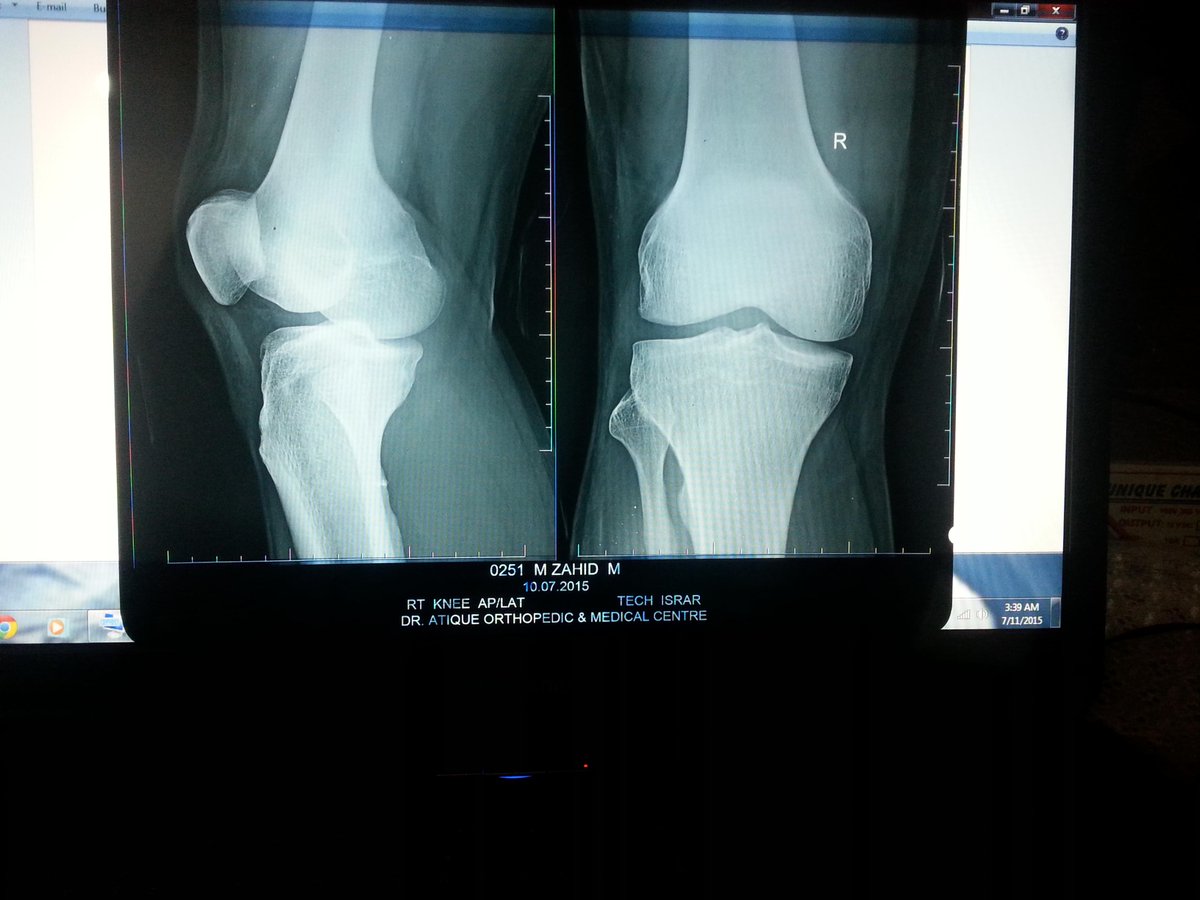 bilawalsays's tweet photo. sehri time - qabooliyat ki gari
so plz #PrayforKnee damaged right Knee ligaments since April 2 + pray 4 Ummah
thanx http://t.co/3jajxeDOaf