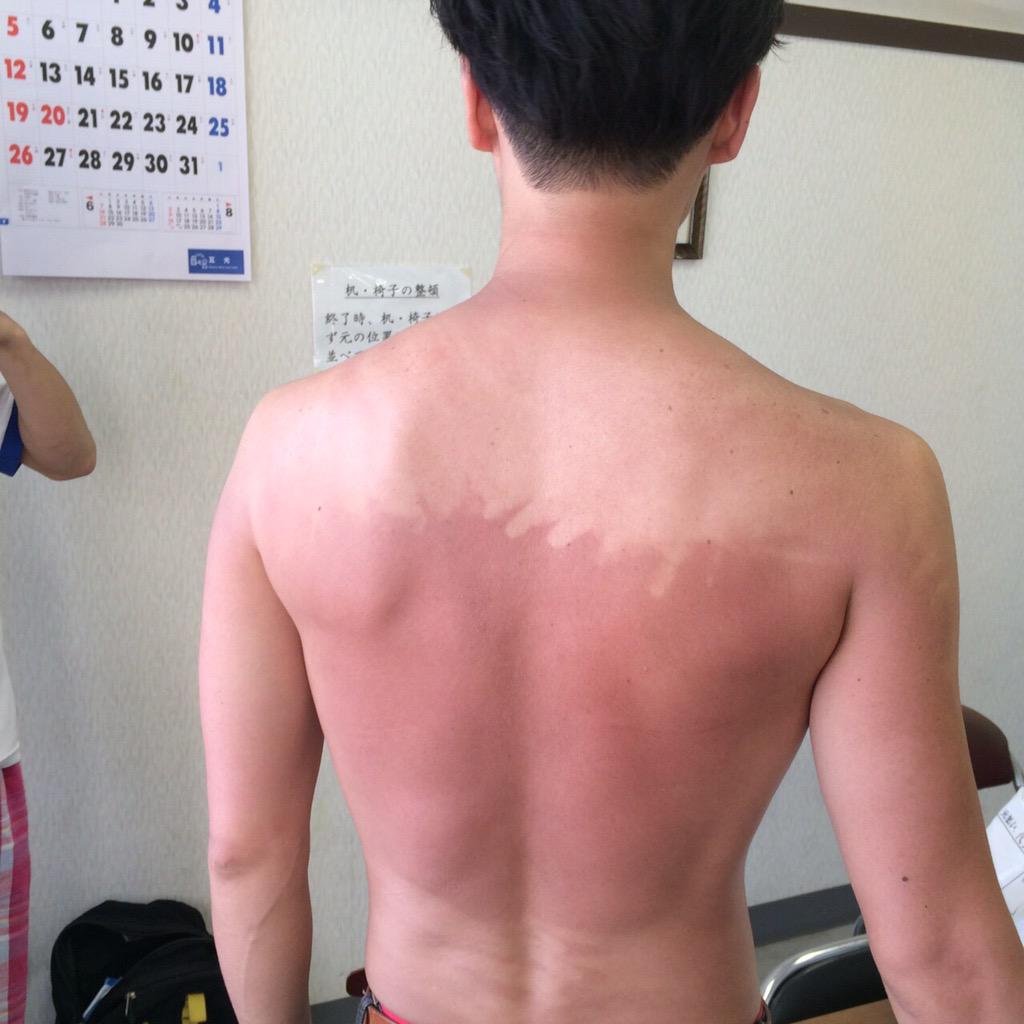 斉藤コータ 最悪な日焼け跡 日焼け止めを手の届く範囲で適当に塗ったらこうなるので注意してください てか日焼け止めの効果すごいのね Http T Co 16isfmpex3