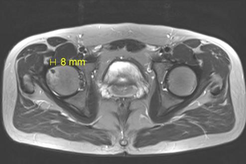 pathtutor_com's tweet image. Osteoid osteoma  #medschool #radpathmatch #bone #pathologists @JMGardnerMD @lapacpiaui @DavidStockmanMD @syntheslide