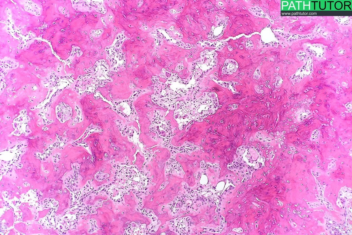 pathtutor_com's tweet image. Osteoid osteoma  #medschool #radpathmatch #bone #pathologists @JMGardnerMD @lapacpiaui @DavidStockmanMD @syntheslide