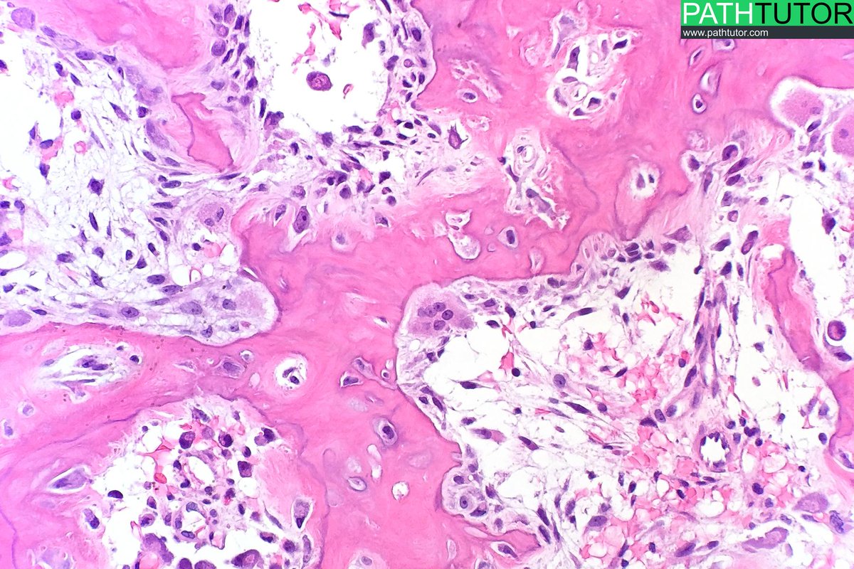 pathtutor_com's tweet image. Osteoid osteoma  #medschool #radpathmatch #bone #pathologists @JMGardnerMD @lapacpiaui @DavidStockmanMD @syntheslide