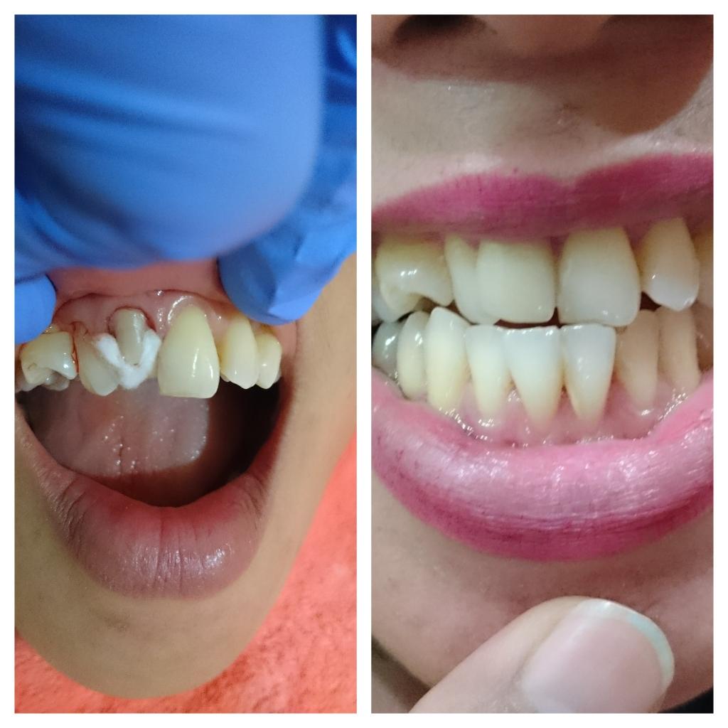 get your smile back with emax crown #dentistBalikpapan