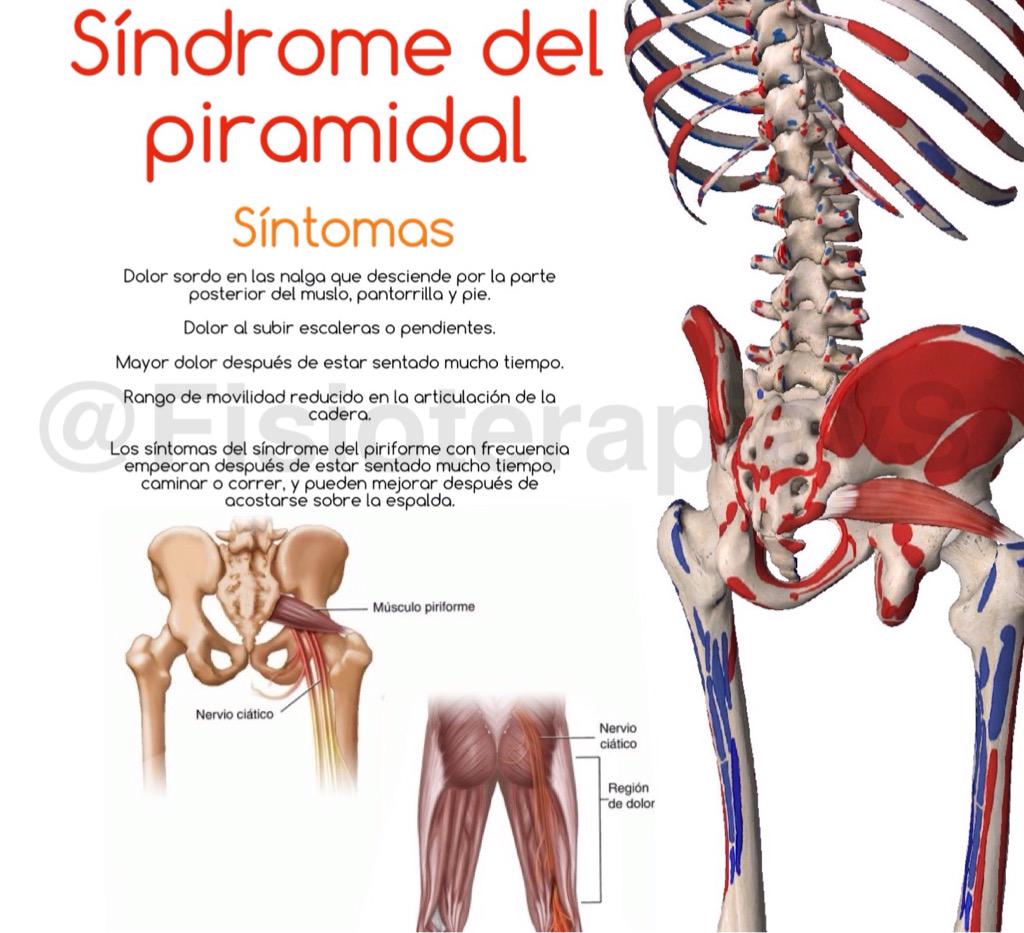 FisioterapiayS's tweet photo. ¿Sabes qué es el Síndrome del piramidal? http://t.co/Cjp9IjolsA