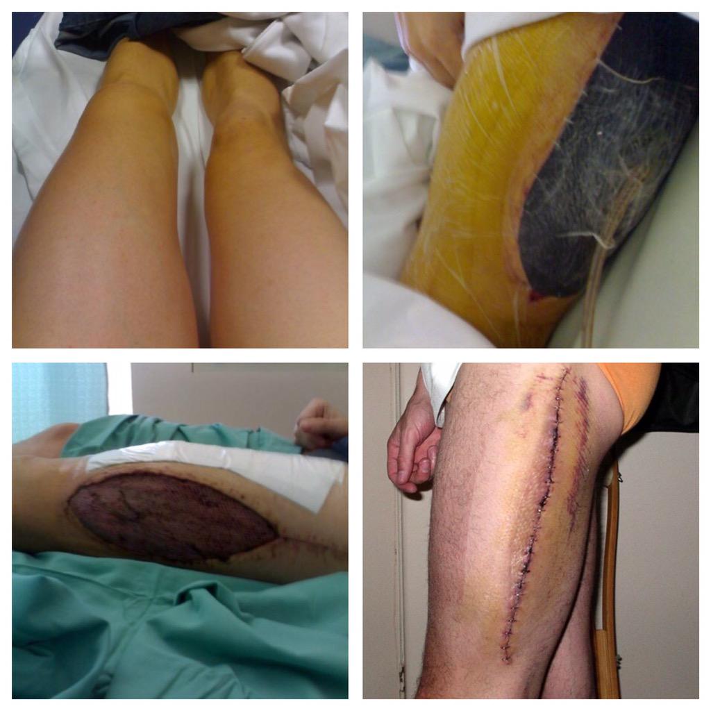 dferroni24's tweet photo. @AFL I don't like the look of this one bit. This is a result to a knee which ended my local footy career. http://t.co/buQwSZIn7g