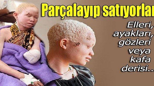 ISRAILBOYKOT's tweet photo. #prevent #persecution #albinism #people #killer      https://t.co/gQeRore9nw http://t.co/ZiIUf2swAl