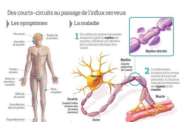 #Recherche et #Scléroseenplaques en #Infographie #SEP sante.lefigaro.fr/actualite/2015…