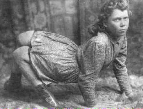 SeriousStrange's tweet image. Ella Harper was born in 1873 with congenital genu recurvatum, a condition which caused her knees to bend backward.