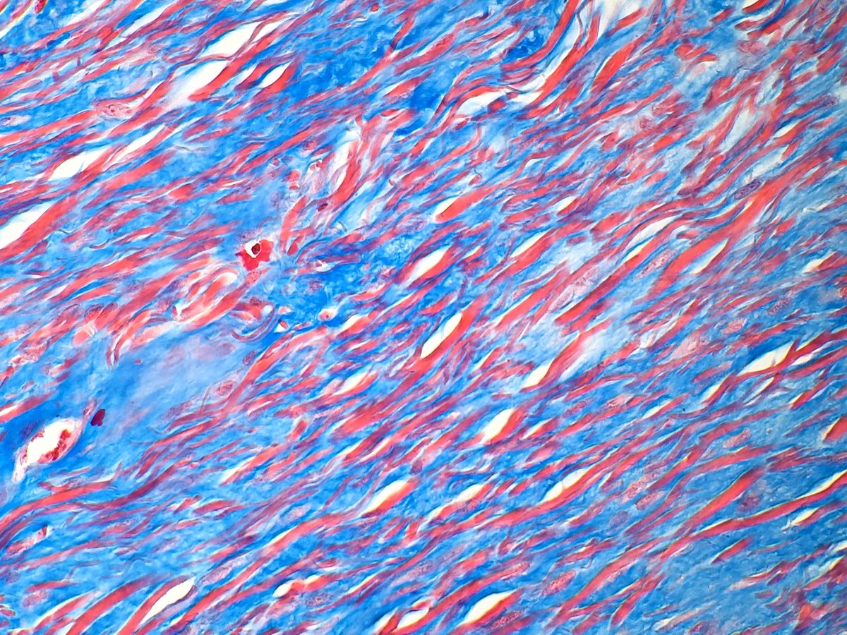 pathtutor_com's tweet image. Ligamentum flavum H/E+trichrome+elastic @JMGardnerMD @syntheslide @mvmd0908  #pathology #histology #medschool