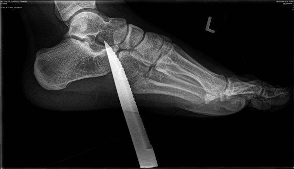 abbalexx's tweet photo. @jimmyfallon I once stepped on a knife sticking out of the ground..Had to have it surgically removed #MyDumbInjury http://t.co/X6Qs4LvEEV