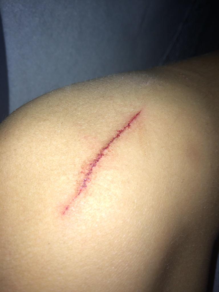 Hurt my knee airsofting