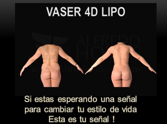 AlfredoHoyosMD's tweet photo. #fatgrafting #tummytuck #vaserhidef #vaser4dlipo #cirujanosesteticos #drcirujano #aestheticsurgery #liposculpture http://t.co/yyjsUvwF4S