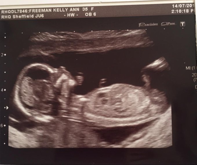 Well this is why Iv not been my self recently😊🍼🍼..baby due 12th January 2016😊. http://t.co/ScX1cpWcJ