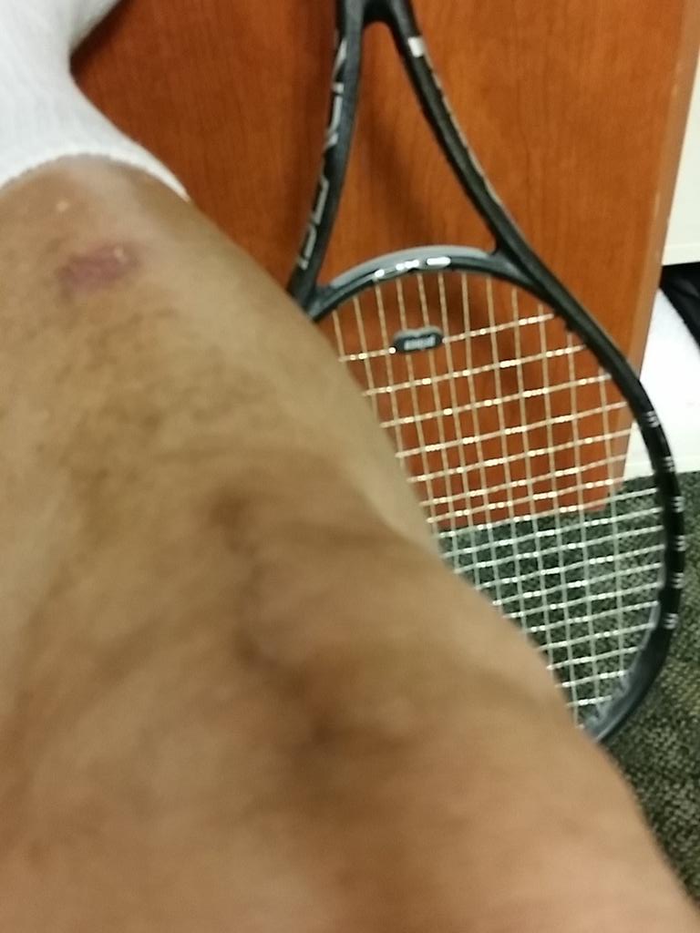 1stUltimateRAM's tweet photo. @mykneeguide Back to the court after 3 ankle &amp; 2 knee surgeries.  Wish me luck. http://t.co/MNewLTH3X4