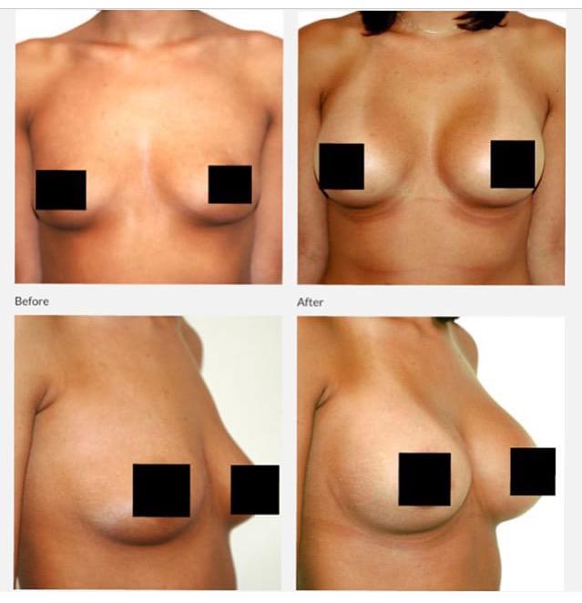 DRolandMD's tweet photo. Look at these results!
24 Year-old Woman With 375cc silicone implants under the muscle by #DrRoland. http://t.co/bkm7mNlB0V