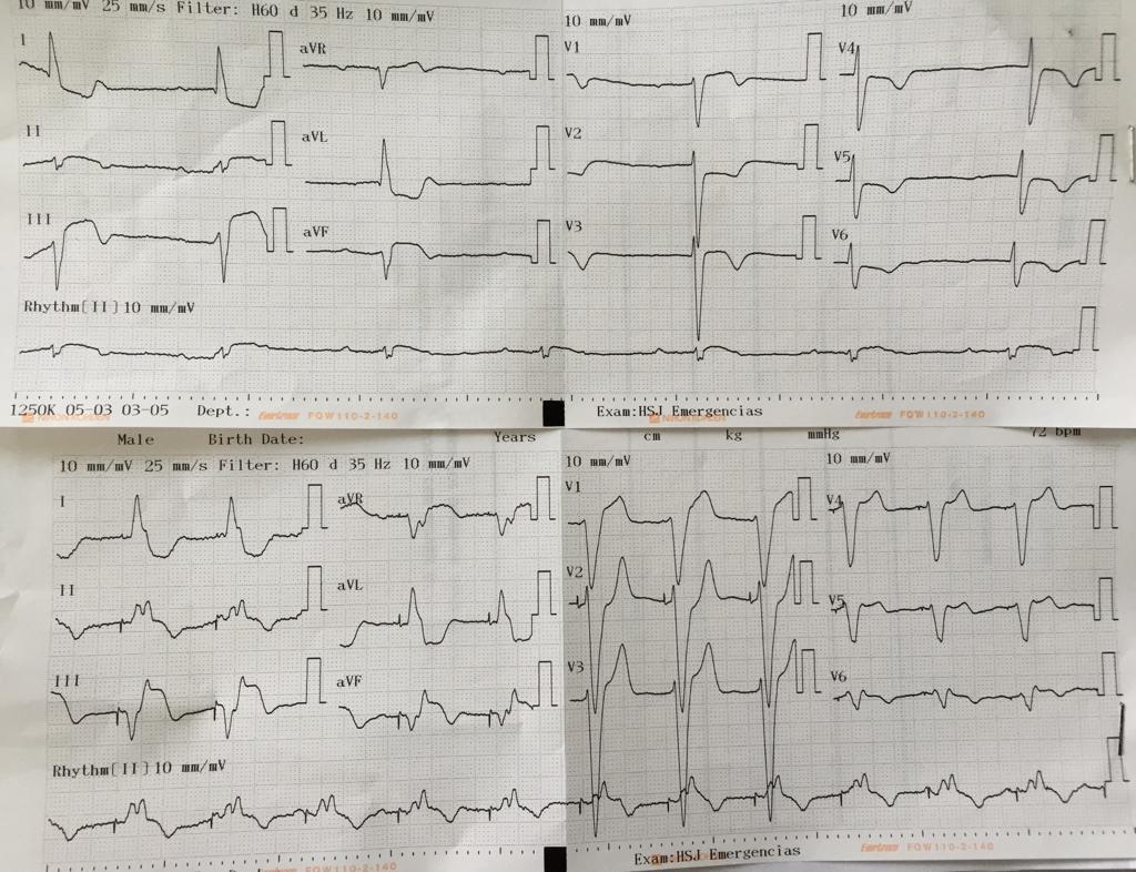 umanamd's tweet image. Inferior STEMI + AV block + ⬇️BP
US-guided IJ pacing in &amp;lt;5min &amp;amp; up to cath
Love it when things run smooth!
#codeSTEMI