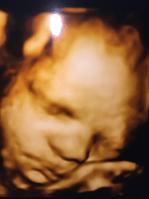 Colan&rsquo;s 4D scan today. He&rsquo;s due on @mialelanixxx &rsquo;s Birthday. I think thats a sign he&rsquo;ll pretty cool<a class="tags" href="/tag/mialelanixxx">@mialelanixxx</a><a href="/tag/happyfriday"class="tags"><span>#happyfriday</span></a><a href="/tag/transgender"class="tags"><span>#transgender</span></a><a href="/tag/update"class="tags"><span>#update</span></a>