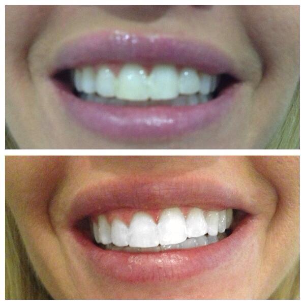 Essexsmileqg41's tweet photo. ‼️sale‼️.....This Wednesday teeth whitening for just £25 !!!! 😁😁 get your slots booked now by calling 01279798433 http://t.co/Fio5rBzsGW